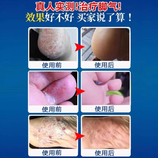 Correction Vidanin Econazole Nitrate Spray 80ml for the treatment of Trichophyton disease, beriberi, itching, peeling, bactericidal medicine, foot odor - Image 4